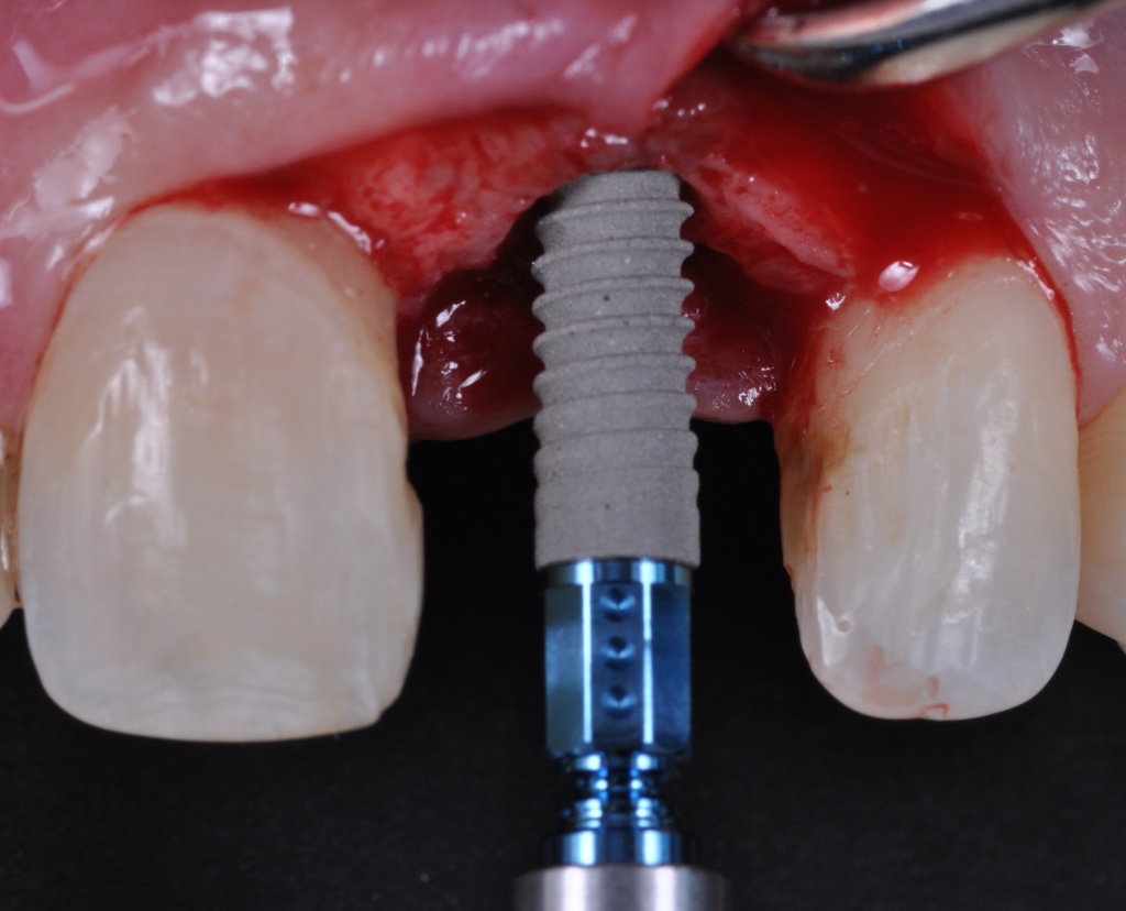Implantes Dentários – Cassio Kampits